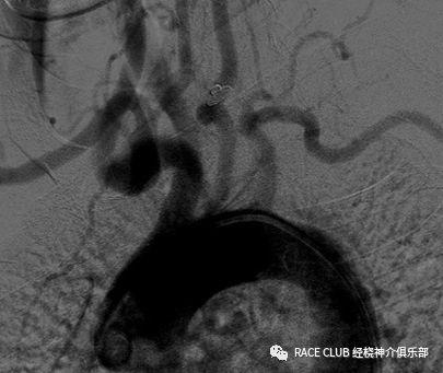造影导丝是什么全脑血管造影术_https://www.jmylbn.com_新闻资讯_第10张