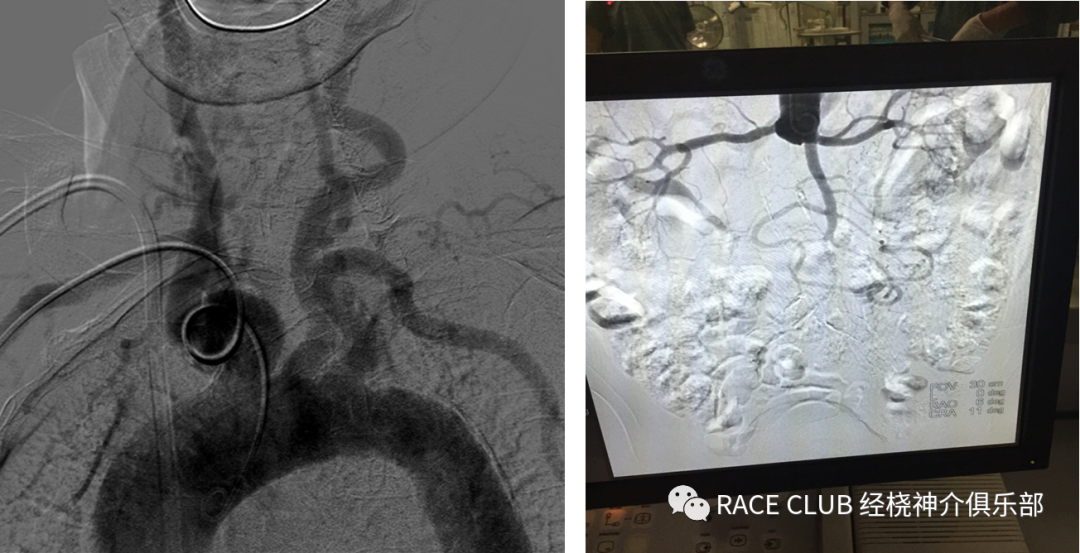 造影导丝是什么全脑血管造影术_https://www.jmylbn.com_新闻资讯_第29张