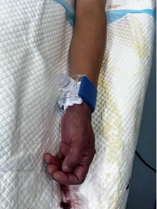 什么叫桡鞘【桡径通神】一例低NIHSS评分，基底动脉闭塞经左桡动脉取栓_https://www.jmylbn.com_新闻资讯_第15张