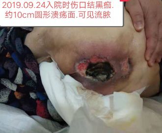 精心治疗悉心护理 解除患者多年痛苦 ——四医院老年科又成功治愈一例四期压疮患者(图2)
