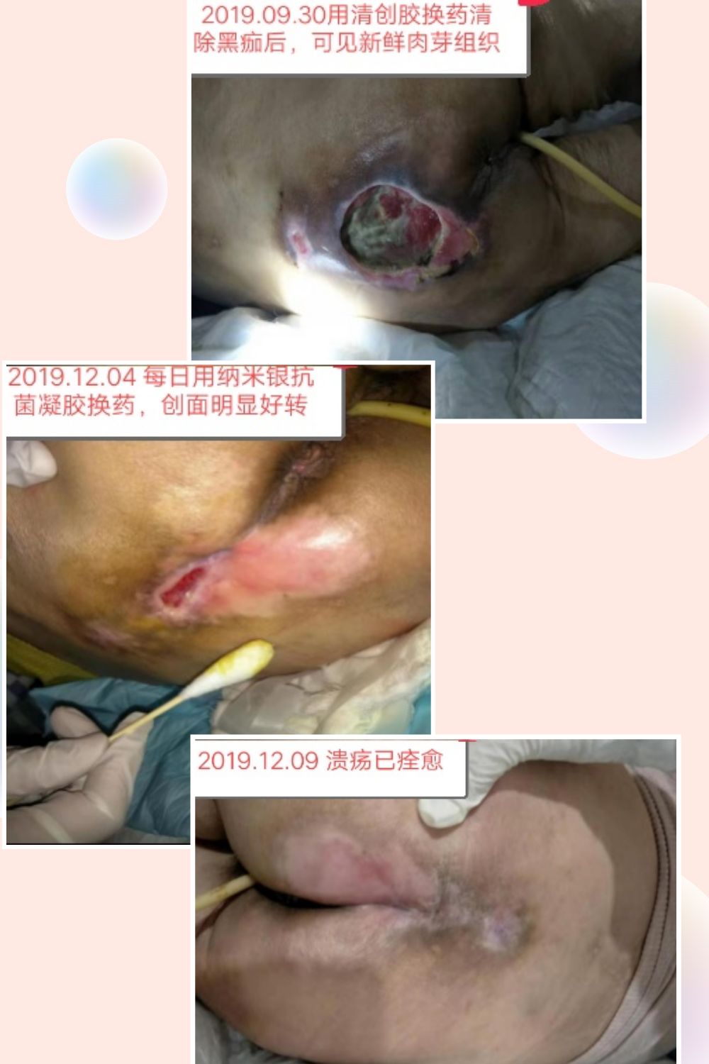 精心治疗悉心护理 解除患者多年痛苦 ——四医院老年科又成功治愈一例四期压疮患者(图5)