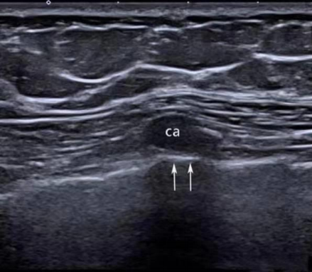 彩超伪像是什么声速失真伪像_https://www.jmylbn.com_新闻资讯_第8张