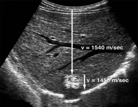 彩超伪像是什么声速失真伪像_https://www.jmylbn.com_新闻资讯_第7张