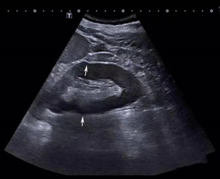 彩超伪像是什么声速失真伪像_https://www.jmylbn.com_新闻资讯_第9张