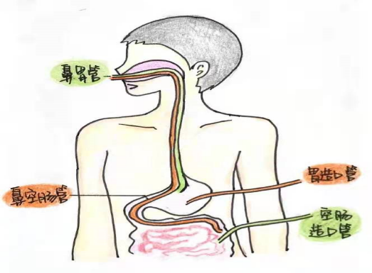 重症生命线鼻空肠管有效维护看这里