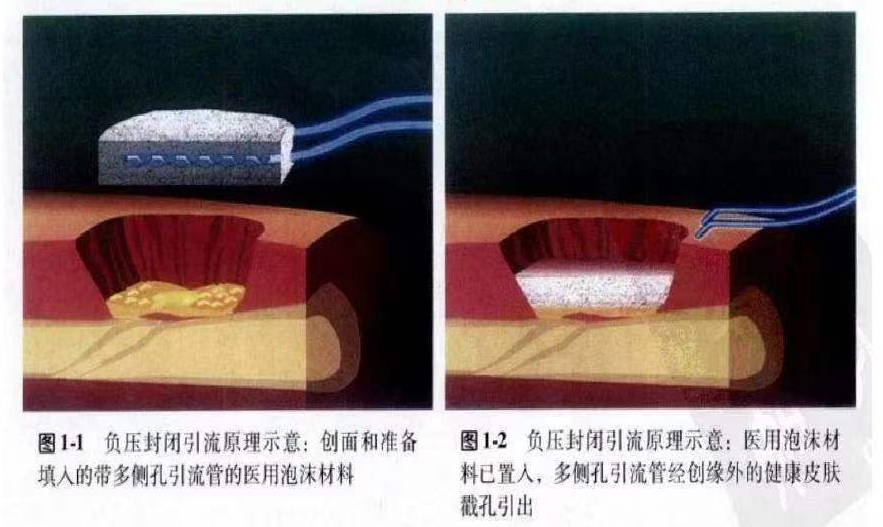 为什么负压引流何为负压封闭引流术？_https://www.jmylbn.com_新闻资讯_第2张