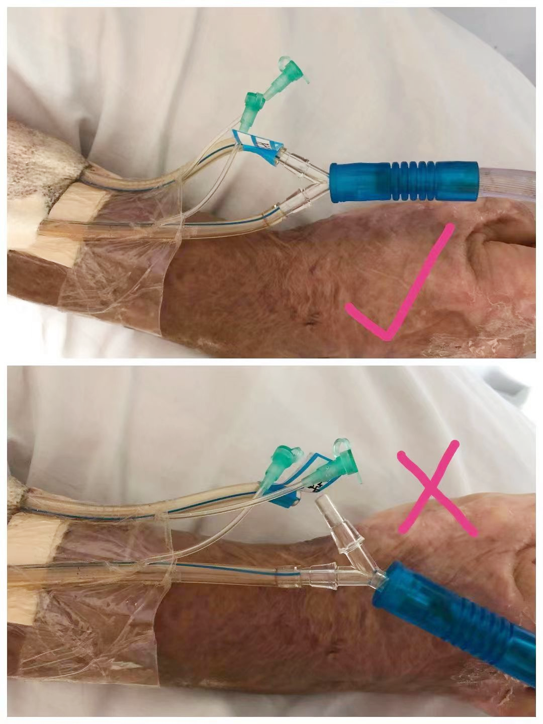 为什么负压引流何为负压封闭引流术？_https://www.jmylbn.com_新闻资讯_第6张