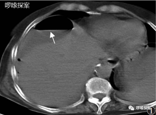 膈下游离气体手术却发现误诊了发热腹痛之谜是什么