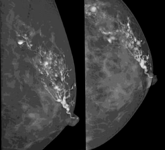 乳腺dr能检查什么乳腺检查｜市中医院引进筛查和诊断乳腺疾病的“利器”——“联影-嫦娥3D”乳腺DR设备_https://www.jmylbn.com_新闻资讯_第5张