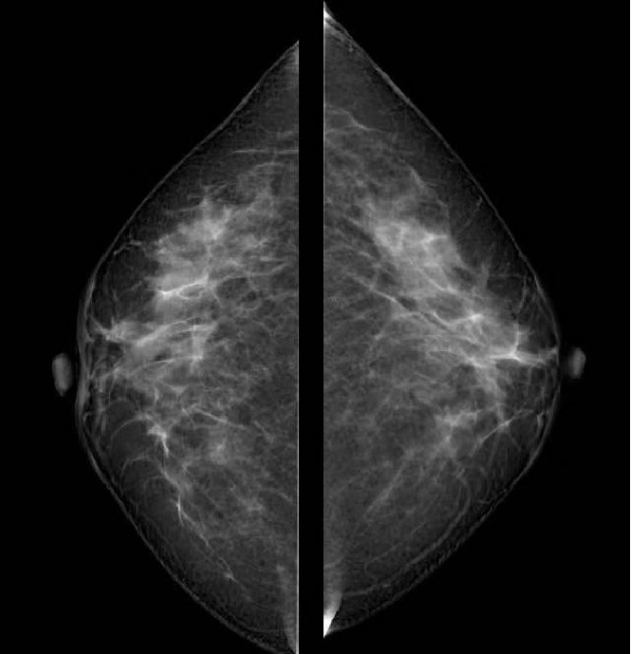 乳腺dr能检查什么乳腺检查｜市中医院引进筛查和诊断乳腺疾病的“利器”——“联影-嫦娥3D”乳腺DR设备_https://www.jmylbn.com_新闻资讯_第4张