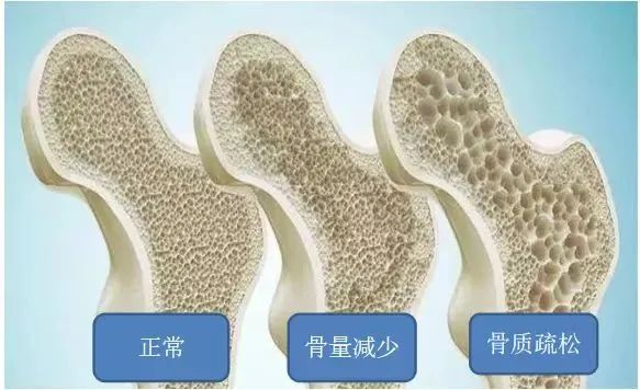 双能x骨密度检测仪为什么非得输入体重身高（健康科普）骨质疏松早知道——让双能X线骨密度仪来测测看_https://www.jmylbn.com_新闻资讯_第2张