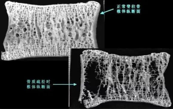 双能x骨密度检测仪为什么非得输入体重身高（健康科普）骨质疏松早知道——让双能X线骨密度仪来测测看_https://www.jmylbn.com_新闻资讯_第3张