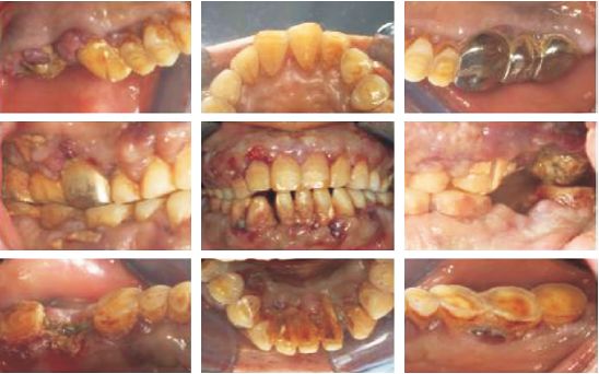 【病例分享】牙周科门诊发现急性白血病2例_医学界-助力医生临床决策