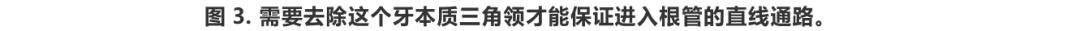 根管冠方预展，一个步骤让根管变得简单！