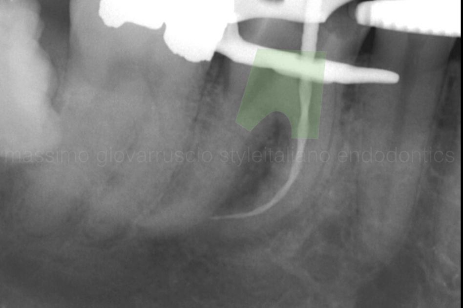 根管冠方预展，一个步骤让根管变得简单！