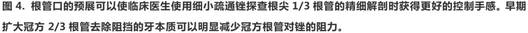 根管冠方预展，一个步骤让根管变得简单！