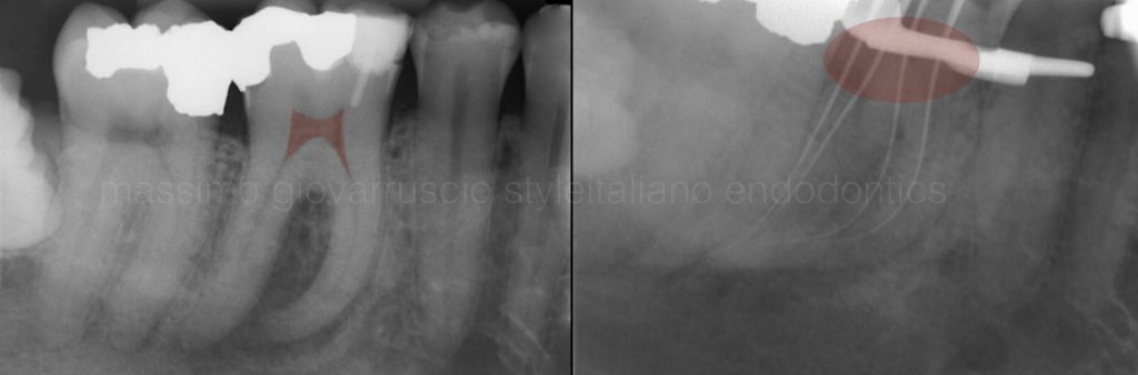 根管冠方预展，一个步骤让根管变得简单！