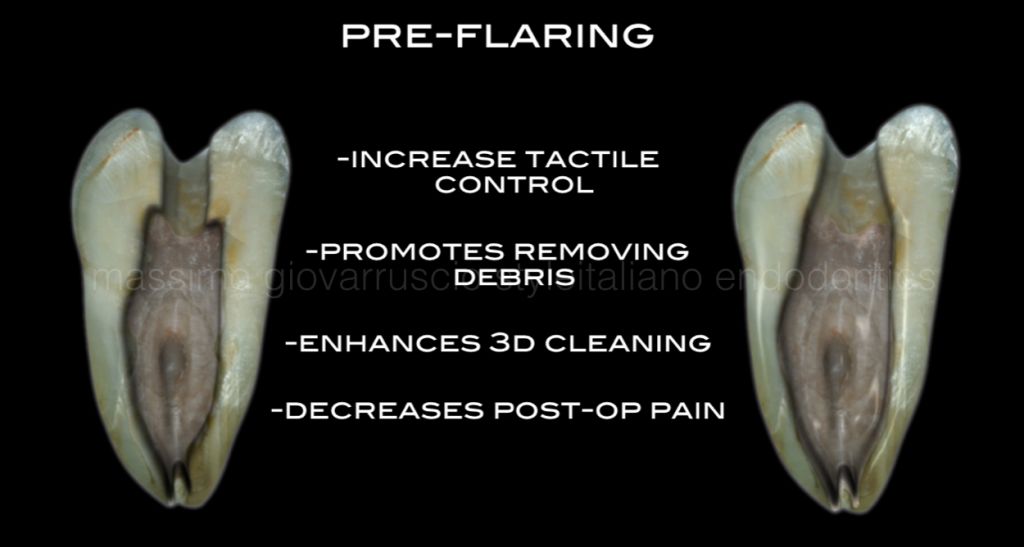 根管冠方预展，一个步骤让根管变得简单！