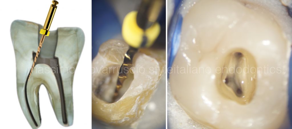 根管冠方预展，一个步骤让根管变得简单！