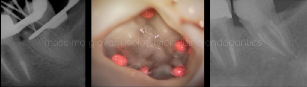 根管冠方预展，一个步骤让根管变得简单！