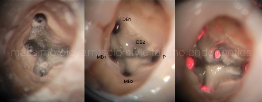 根管冠方预展，一个步骤让根管变得简单！