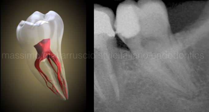 根管冠方预展，一个步骤让根管变得简单！