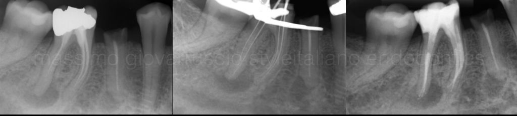 根管冠方预展，一个步骤让根管变得简单！