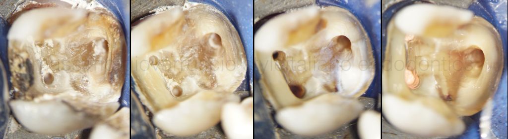 根管冠方预展，一个步骤让根管变得简单！