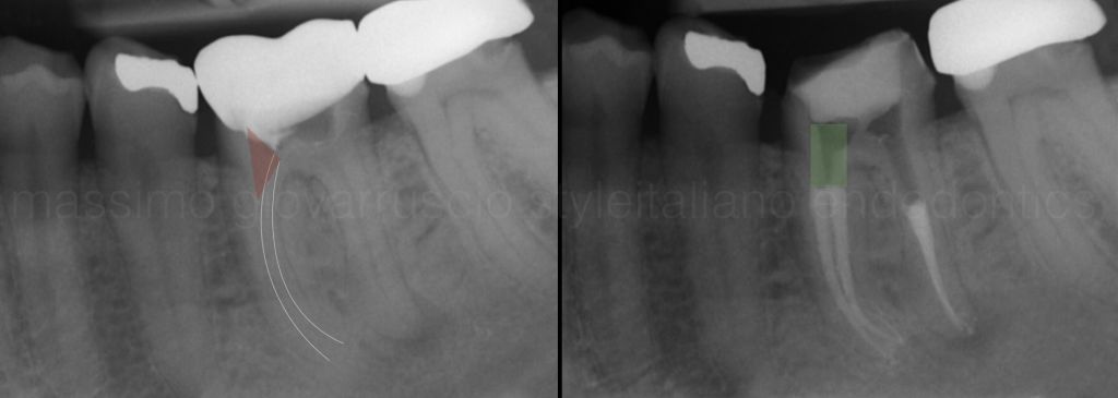 根管冠方预展，一个步骤让根管变得简单！