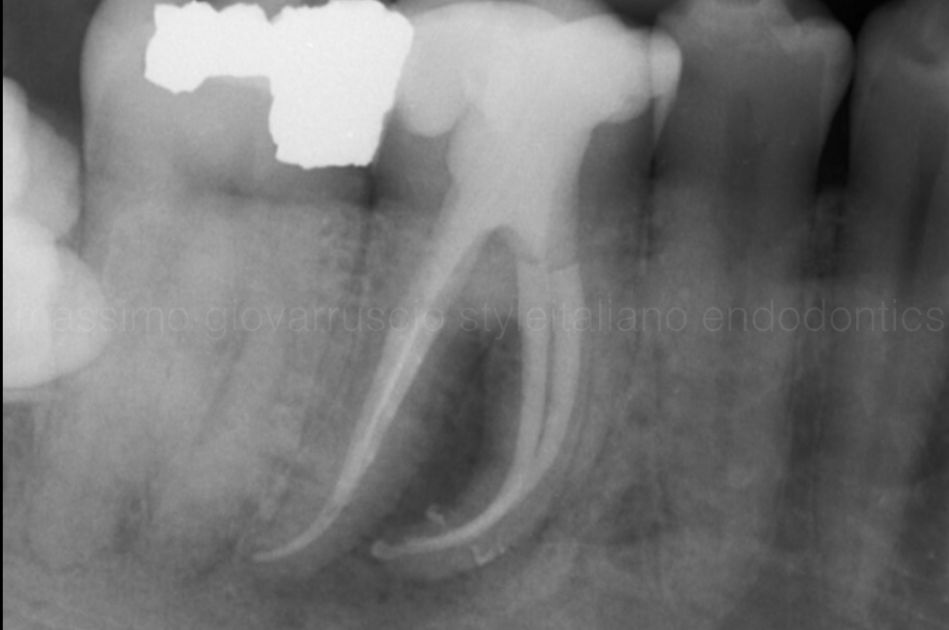 根管冠方预展，一个步骤让根管变得简单！