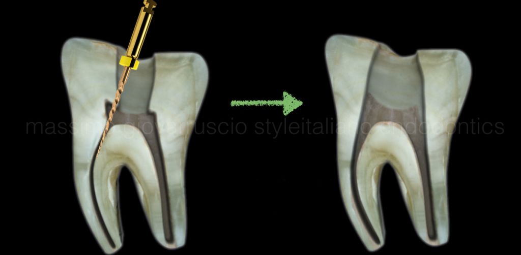 根管冠方预展，一个步骤让根管变得简单！