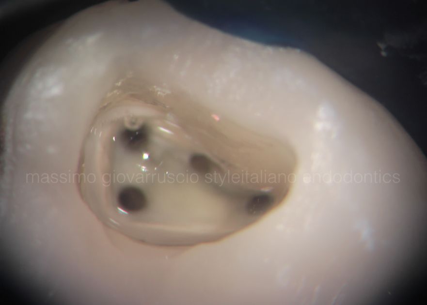 根管冠方预展，一个步骤让根管变得简单！