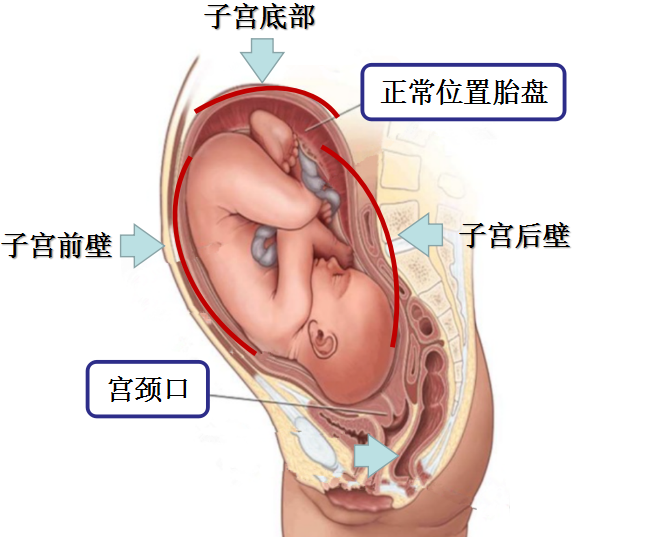 胎盘前壁胎儿图图片