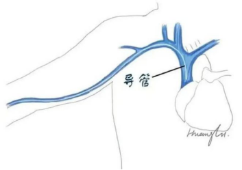 电子输注泵起什么作用精准把控，“泵”向健康！便携式化疗泵你了解多少？_https://www.jmylbn.com_新闻资讯_第12张