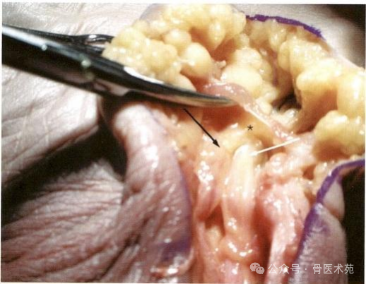 手术入路：腕水平尺神经手术入路（详细手术图解）