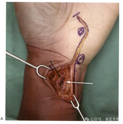 手术入路：腕水平尺神经手术入路（详细手术图解）