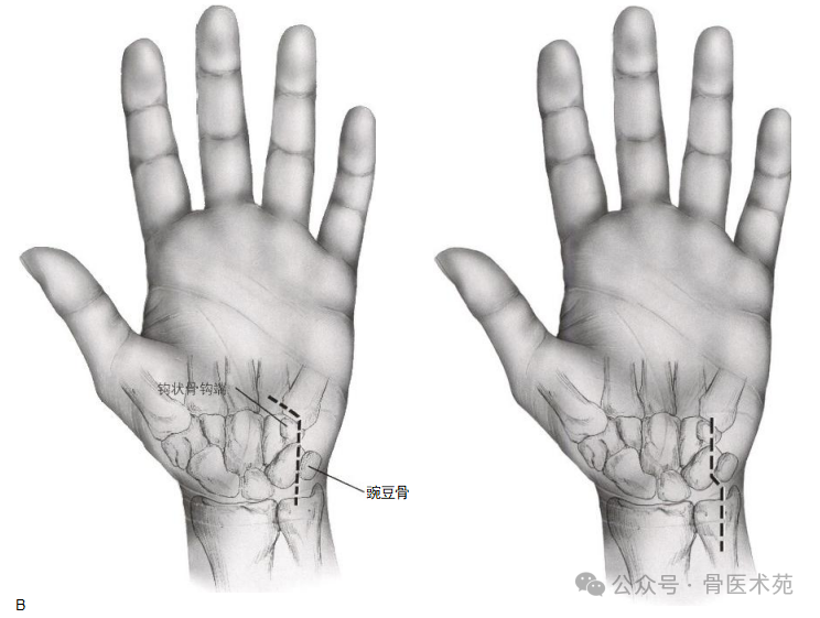 手术入路：腕水平尺神经手术入路（详细手术图解）
