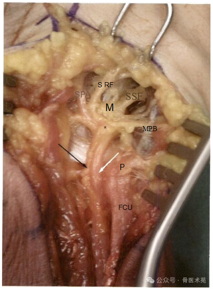 手术入路：腕水平尺神经手术入路（详细手术图解）