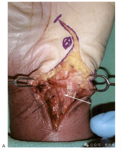 手术入路：腕水平尺神经手术入路（详细手术图解）