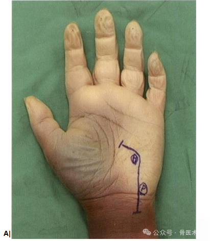 手术入路：腕水平尺神经手术入路（详细手术图解）