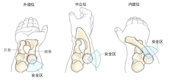 复杂性肘关节骨折的手术治疗技术