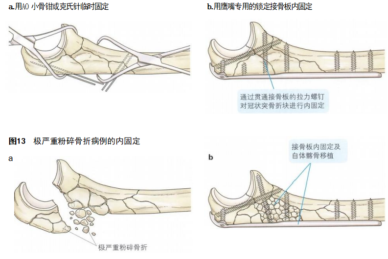 复杂性肘关节骨折的手术治疗技术