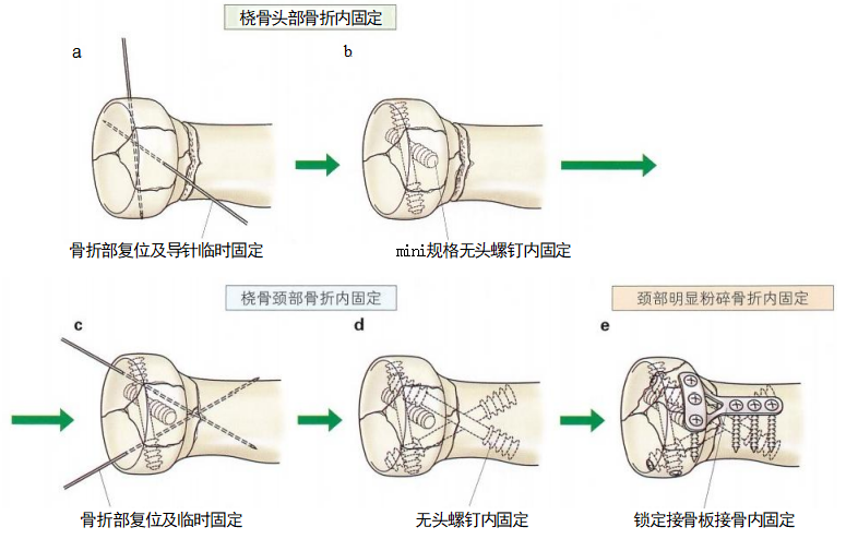 复杂性肘关节骨折的手术治疗技术