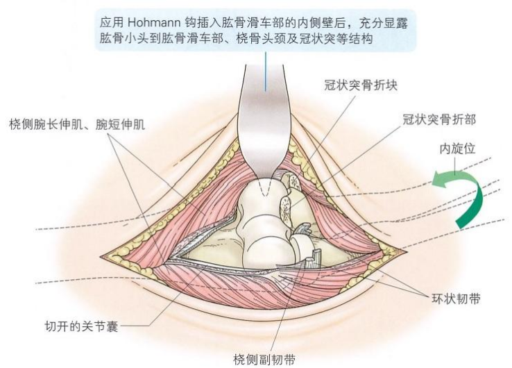 复杂性肘关节骨折的手术治疗技术