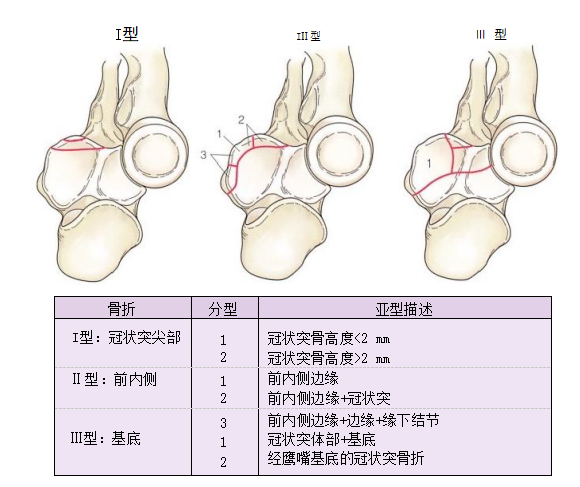 复杂性肘关节骨折的手术治疗技术