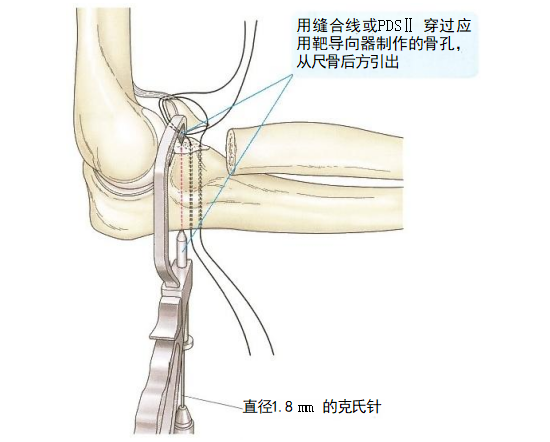 复杂性肘关节骨折的手术治疗技术