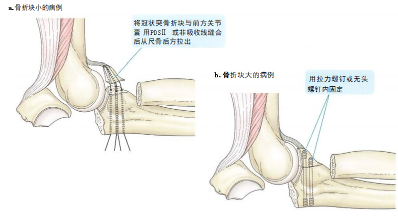 复杂性肘关节骨折的手术治疗技术