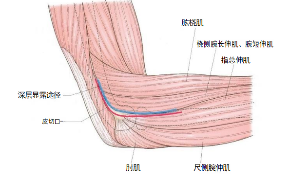 复杂性肘关节骨折的手术治疗技术