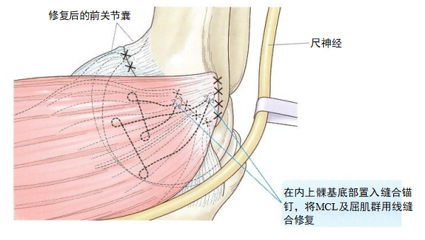复杂性肘关节骨折的手术治疗技术