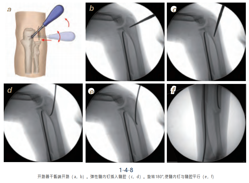 儿童尺桡骨干骨折弹性髓内钉技术（看完这篇就够了）